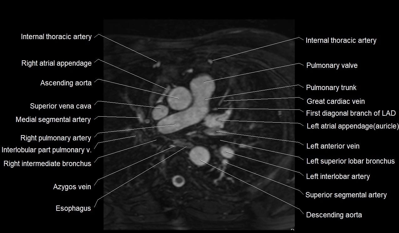 MRI heart coronary arteries and coronary veins anatomy axial image 8.webp